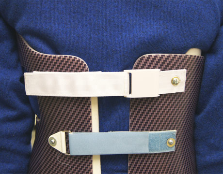 A Smarter Treatment for Scoliosis - ASME